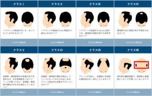 かつらや植毛ってどうなの？値段が気になるよね…
