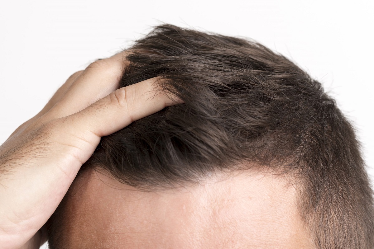 抜け毛薄毛予防に…ベタベタの頭皮を解消する方法