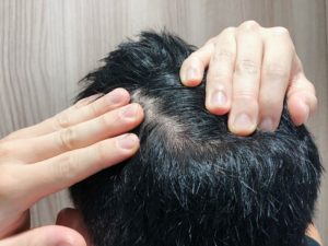 あなたの頭皮環境は大丈夫？色や柔らかさでチェック