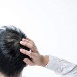 抜け毛を初めて感じた年齢とその時の特徴
